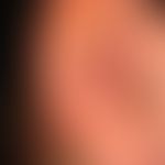 Psoriasis guttata: de novo aufgetretene, 0,1-2,0 cm große, rötliche, raue Papeln und&nbsp; Plaque...