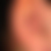 Psoriasis guttata: de novo aufgetretene, 0,1-2,0 cm große, rötliche, raue Papeln und&nbsp; Plaque...