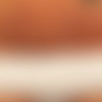 Psoriasis guttata: de novo aufgetretene, 0,1-2,0 cm große, rötliche, raue Papeln und&nbsp; Plaque...