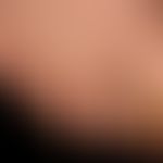 Onychogrypose: verkrümmter und verdickter Nagel.

&nbsp;
