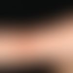 Kollagenose, reaktive perforierende:&nbsp;chronisch dynamische (seit 1 Jahr kontinuierliche Neubi...