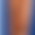 Leishmaniasis&nbsp;kutane: nach einem Urlaub aufgetretene,wenig symptomatische, rundliche, rot-br...
