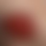 Leishmaniasis kutane solitäre (klassische Orientbeule): flach ulzerierte, wenig schmerzhafte&nbsp...