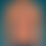 Dyskeratosis follicularis: randbetonte entzünldiceh Plaque- Abb. entnommen aus: Dorf IL et al. (2...
