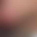 Histiozytose intralymphatische: Klinischer&nbsp; Befund mit mäßig angeschwollener und geröteter K...