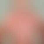 Pemphigus foliaceus, endemischer: Schwere, generalisierte Form der Erkrankung mit blättriger&nbsp...