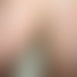 Pemphigus foliaceus, endemischer: Schwere, generalisierte Form der Erkrankung mit groblamellärer ...