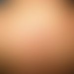 Pemphigus foliaceus, endemischer:&nbsp;Lokalisierte, weniger schwer verlaufende&nbsp;Form der Erk...