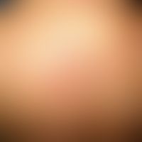 Pemphigus foliaceus, endemischer:&nbsp;Lokalisierte, weniger schwer verlaufende&nbsp;Form der Erk...