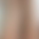 Kokain-induzierte Vaskulitis: Kleingefäßvaskulitis bei chonischem Kokainabusus. Abb entnommen aus...