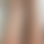 Kokain-induzierte Vaskulitis: Kleingefäßvaskulitis bei chonischem Kokainabusus. Abb entnommen aus...