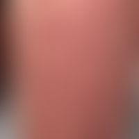 Pityriasis lichenoides (et varioliformis) acuta (Typ febrile papulo-ulzeröse Mucha-Habermann-Erkr...