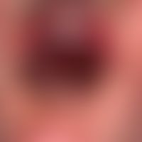 Pityriasis lichenoides (et varioliformis) acuta (Typ febrile papulo-ulzeröse Mucha-Habermann-Erkr...