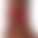Erythema induratum (Bazin):&nbsp;Großflächige, stellenweise konfluierte Ulzera und idurierte Plaq...