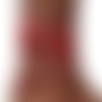 Erythema induratum (Bazin):&nbsp;Großflächige, stellenweise konfluierte Ulzera und idurierte Plaq...