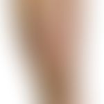 Erythema induratum (Bazin):&nbsp;Frische und bereits abgeheilte ulzerierte Knoten und PLaques bei...
