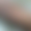 Lichenoides Tuberkulid: disseminierte follikuläre Papeln und konfluierte schuppige Plaques. Abb. ...