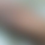 Lichenoides Tuberkulid: disseminierte follikuläre Papeln und konfluierte schuppige Plaques. Abb. ...