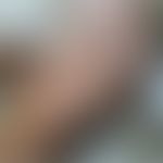 Lichenoides Tuberkulid: disseminierte follikuläre Papeln und konfluierte schuppige Plaques. Abb. ...