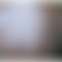 Papulonekrotisches Tuberkulid: Buntes Bild mit unterschiedlichen Stadien (Narben, nicht-follikulä...
