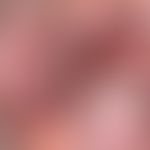 Grinspan-Syndrom: Zeichen des bds. oralen Lichen planus mit hyperpigmentierten Plaques.&nbsp;Abb....