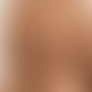 Grinspan-Syndrom: Klinische Zeichen des Pemphigus vulgaris. Abb. entnommen aus: Saddik A et al. 2...