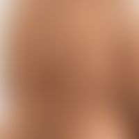 Grinspan-Syndrom: Klinische Zeichen des Pemphigus vulgaris. Abb. entnommen aus: Saddik A et al. 2...