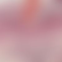 Stratum corneum/Porokeratose: fokaler Parakeratosekegel über einem Epidermissegment mit Dyskerato...