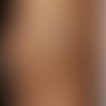 Lupus erythematodes profundus (Lupus-Pannikulitis): flächenhaft induriertes, hyperpigmentiertes A...