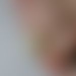 Onychogrypose: schwere Ausprägung einer isolierten Form der Onychogrypose mit grotesk eingerollte...