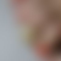 Onychogrypose: schwere Ausprägung einer isolierten Form der Onychogrypose mit grotesk eingerollte...