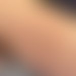 Erythema migrans: seit wenigen Wochen bestehendes zentrifugal migrierendes, symptomloses Erythem....