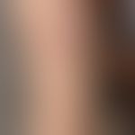 Erythema migrans:&nbsp;Beginnende trizonale, schießscheibenartige Plaque nach Zeckenstich vor 4 T...