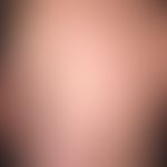 Bettwanze:&nbsp;multiple, teils linear angeordnete urtikarrielle Paplen und Plaques.&nbsp;Abb.ent...