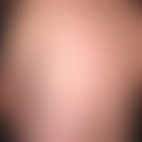 Bettwanze:&nbsp;multiple, teils linear angeordnete urtikarrielle Paplen und Plaques.&nbsp;Abb.ent...