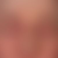 Hertoghesches Zeichen:&nbsp;schwere atopische Dermatitis mit Lidbefall. Rarefkizierung der latera...