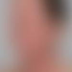 Atopische Head and Neck-Dermatitis: schwere disseminierte Ekzemreaktion an Gesichts- und Halspart...