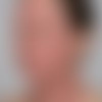 Atopische Head and Neck-Dermatitis: schwere disseminierte Ekzemreaktion an Gesichts- und Halspart...