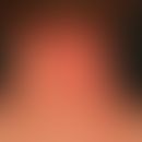 Atopische Head and Neck-Dermatitis: großflächige, unscharf begrenzte, lichenifizierte stark jucke...