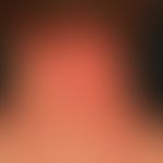 Atopische Head and Neck-Dermatitis: großflächige, unscharf begrenzte, lichenifizierte stark jucke...