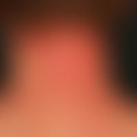 Atopische Head and Neck-Dermatitis: großflächige, unscharf begrenzte, lichenifizierte stark jucke...