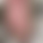 CTLA-4-Haploinsuffizienz: schwere atopische Dermatitis seit frühester Kindheit mit Befall der Ext...