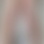CTLA-4-Haploinsuffizienz: schwere atopische Dermatitis mit Befall der Extremitäten (Abb. entnomme...