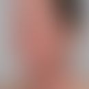 Atopische Head-and-Neck-Dermatitis: schwere disseminierte Ekzemreaktion an Gesichts- und Halspart...