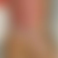 Streptococcus pyogenes:&nbsp;Schwerer ulzerierter Weichteilabszess. Abb. entnommen aus:&nbsp;Jant...