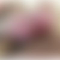 Bakterielle Balanoposthtis durch Streptococcus pyogenes:&nbsp;flächige Rötungen und fokales Nässe...