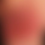 Differenzialdiagnose: Lupus erythematodes tumidus&nbsp;

Diagnose: Eosinophile Zellulitis (Wells-...