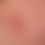 Differenzialdiagnose: Lupus erythematodes tumidus:

Diagnose: Kutane plaqueförmige (nicht knotige...