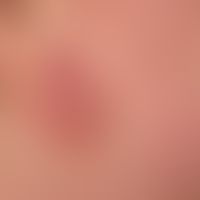 Differenzialdiagnose: Lupus erythematodes tumidus:

Diagnose: Kutane plaqueförmige (nicht knotige...