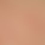 Differenzialdiagnose: Immunrekonstitutions-Follikulitis

Diagnose: Malassezia-Follikulitis. Disse...